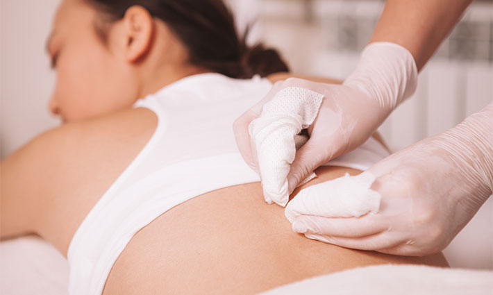 Akné na chrbte, ramenách a v dekolte: Ako sa ho zbaviť