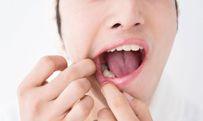 Čo pomáha na afty? Tipy, ktoré prinesú úľavu