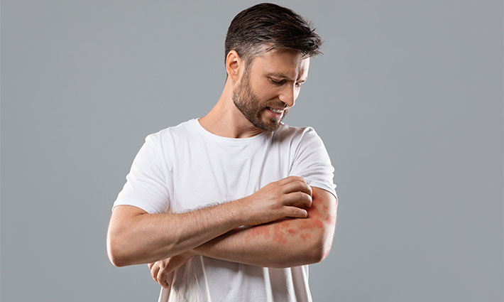Atopický ekzém: Ako ho rozpoznať, upokojiť a správne sa starať o pokožku